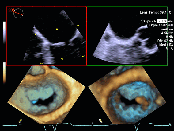 4D TEE Video Prikaz Mitralne Valvule